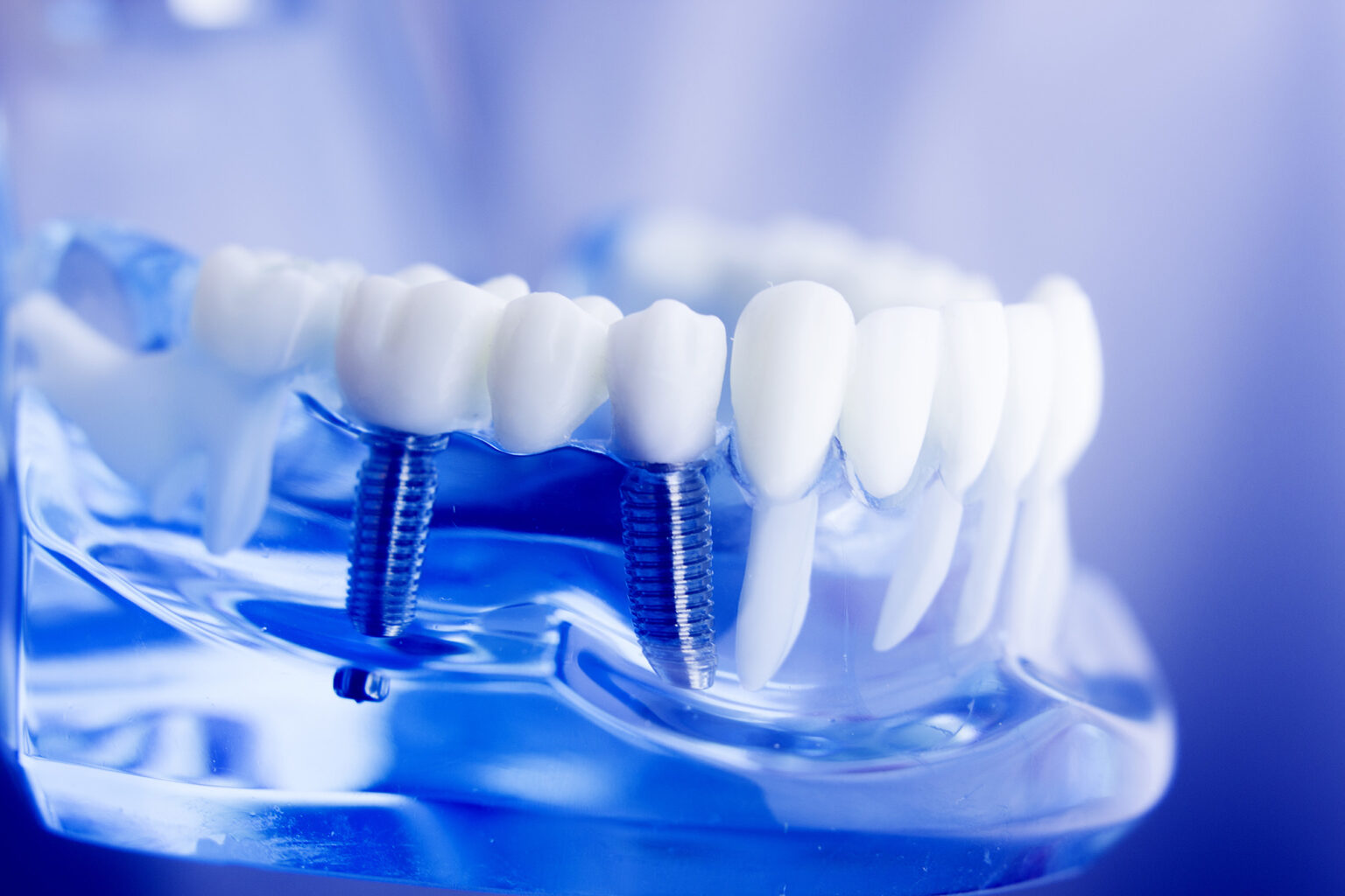 dental implants in se calgary