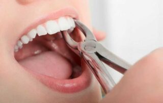 Can Wisdom Teeth Extraction Change the Shape of Your Face?