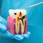 Dentist performing root canal treatment in SE Calgary