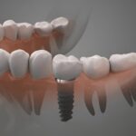 Are Dental Implants Painful? – What to Expect During and After Treatment