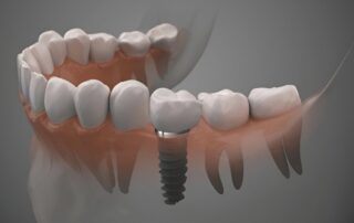 Are Dental Implants Painful? – What to Expect During and After Treatment