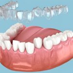 How Does Invisalign Straighten Teeth? Step-by-Step Guide