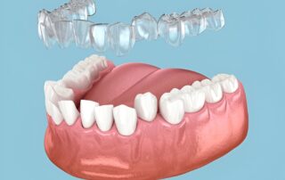 How Does Invisalign Straighten Teeth? Step-by-Step Guide