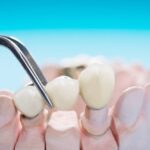 Dental Bridges Explained: How They Replace Missing Teeth Naturally
