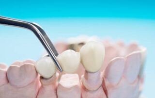 Dental Bridges Explained: How They Replace Missing Teeth Naturally